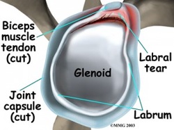 Glenoid Labrum Tear