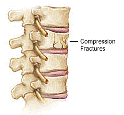 Lumbar & Thoracic Spine Fracture
