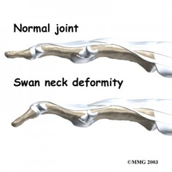 Swan Neck Deformity