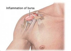 Shoulder Bursitis